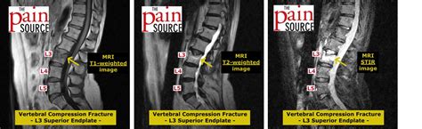 compression test fracture|compression fracture ct vs mri.